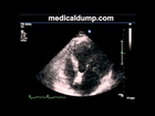 Mitral Valve Prolapse - Mitral Regurgitation - Transthoracic Echocardiogram (TTE)